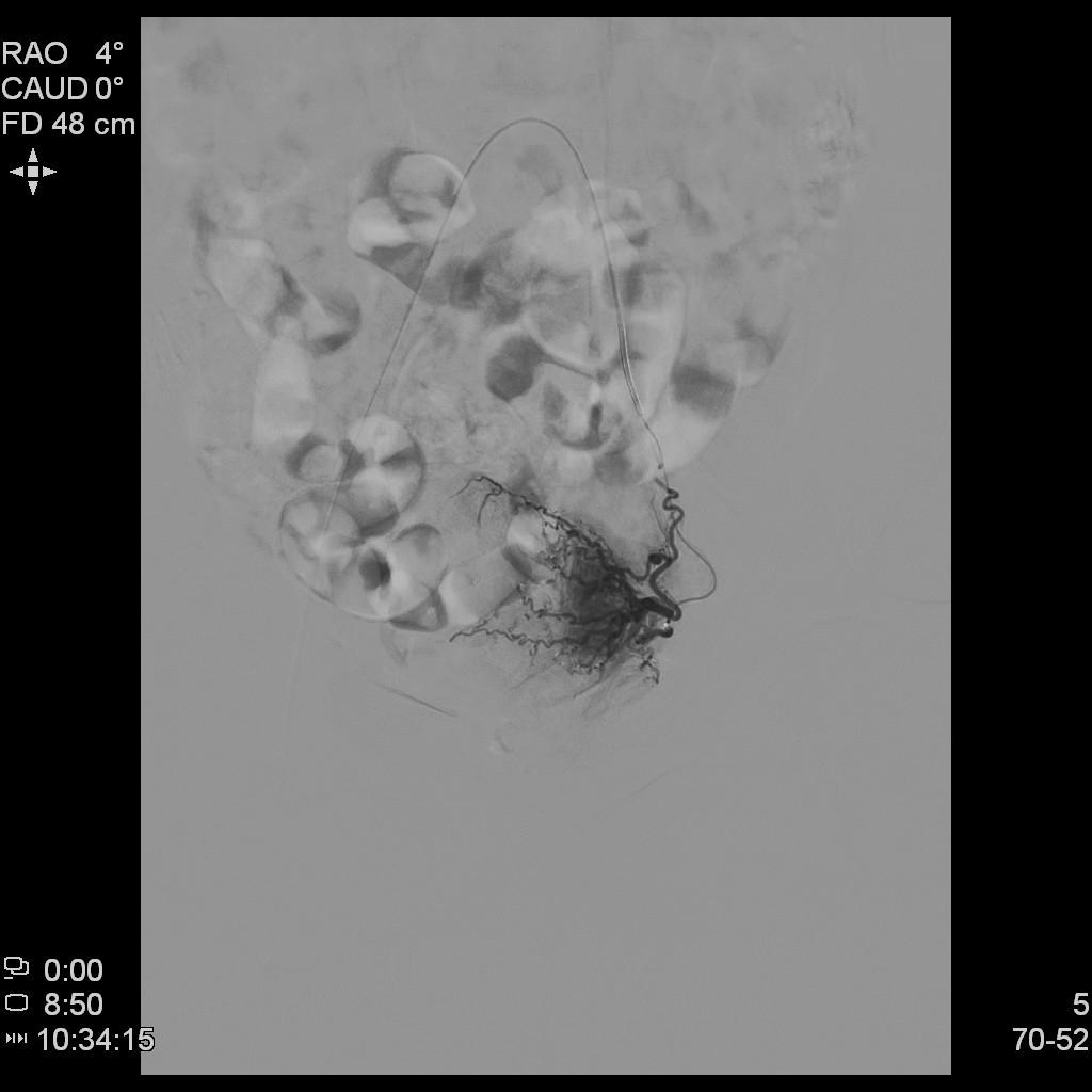 「不死的癌症」之克星——子宫腺肌症介入栓塞治疗