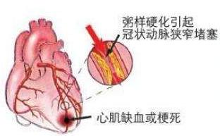 身边很多同事都得了冠心病，到底什么是冠心病？有什么治疗方法？