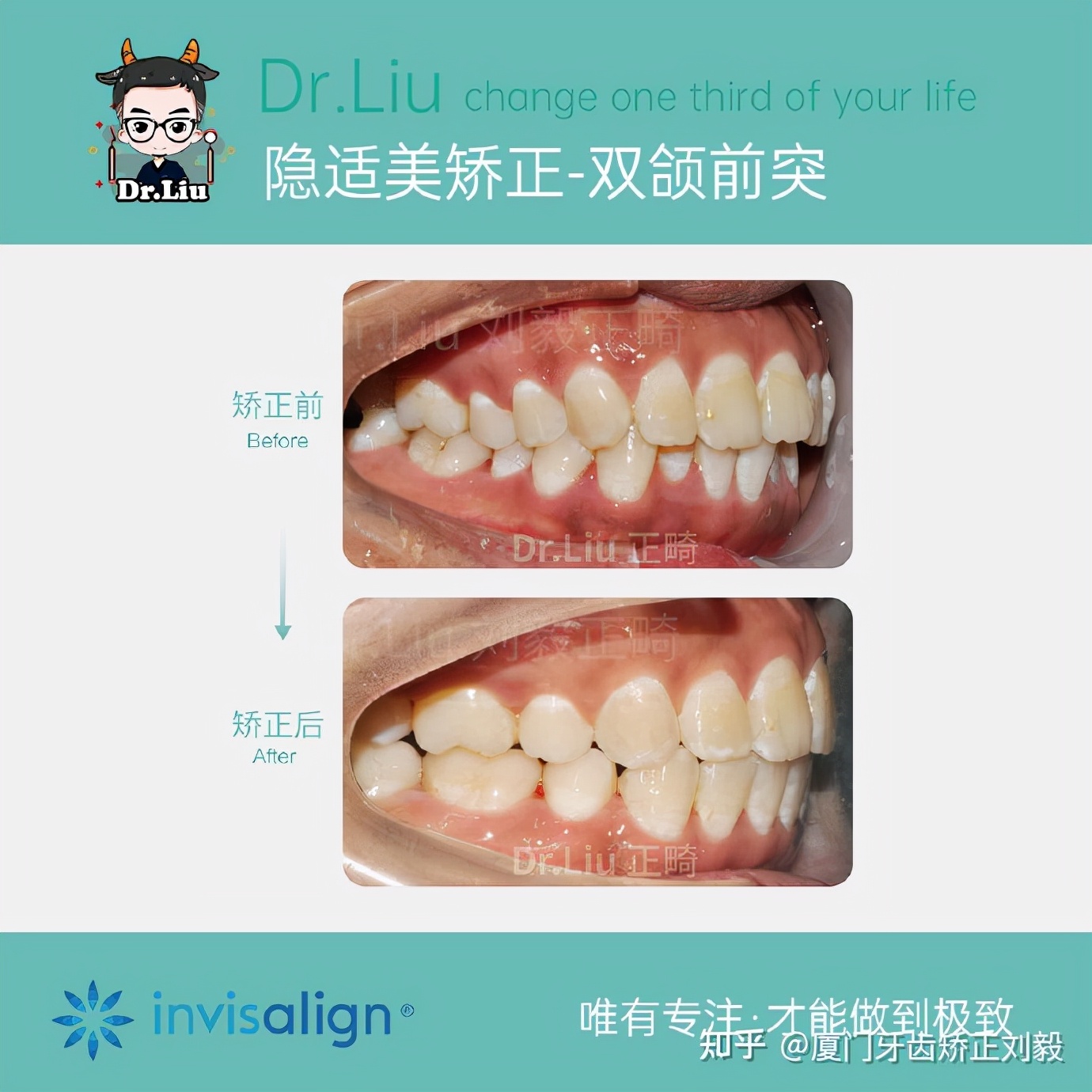 下嘴唇厚且外翻牙齿矫正,深覆合牙齿矫正嘴凸