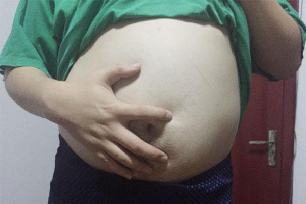 脾虚痰湿肥胖真实有效减肥案例,脾虚型肥胖减肥中成药