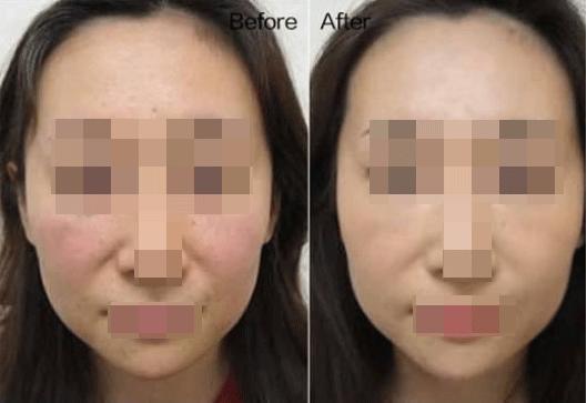 法令纹显老10岁三种方法帮助改善,脸上有法令纹最好解决的办法