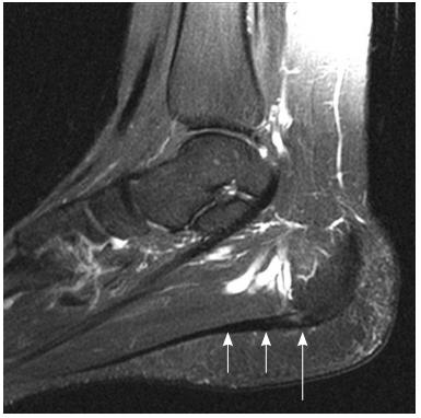 足底感觉有刺痛感是足底筋膜炎吗,路走多了脚底板疼可以用冰敷嘛