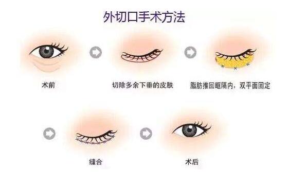 去严重眼袋最安全最有效的方法,年轻人去眼袋最安全最有效的方法