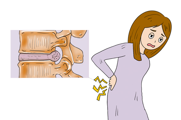 闪腰吃什么药效果好减轻痛苦,闪腰了恢复期会有酸痛吗