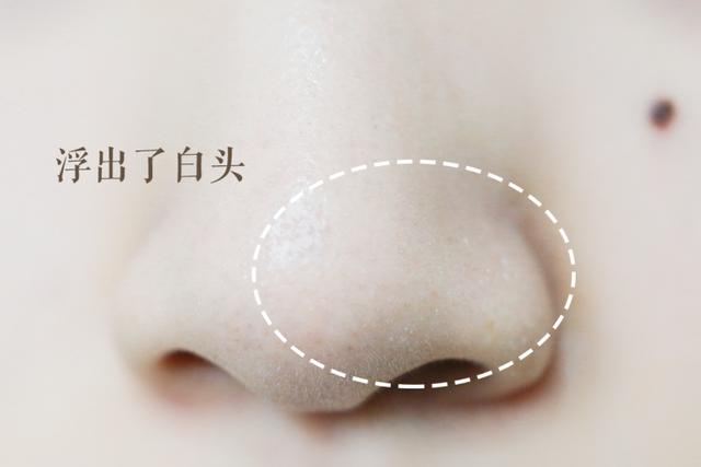 去黑头巨好用护肤品套装,草莓鼻去黑头套装