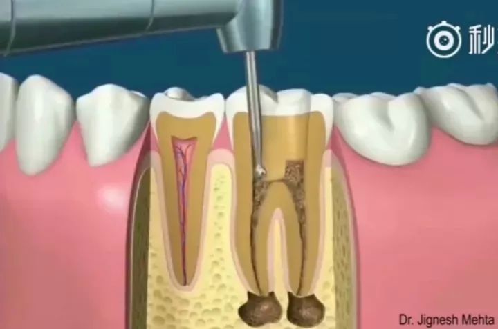 有蛀牙但没时间做根管怎么办,蛀牙多严重做根管