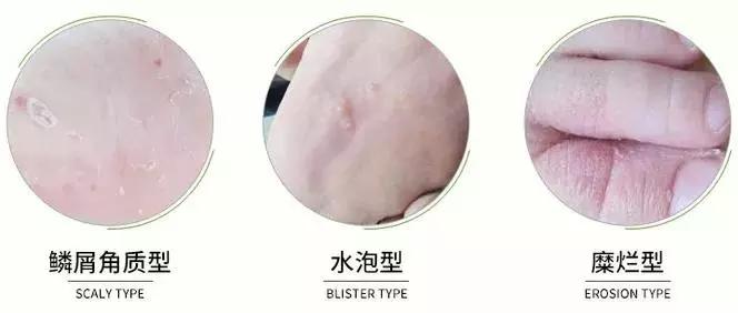 香港脚臭喷雾哪个好用,香港脚痊愈的征兆