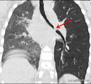 小儿气管镜怎么检查,小儿ct检查全过程视频