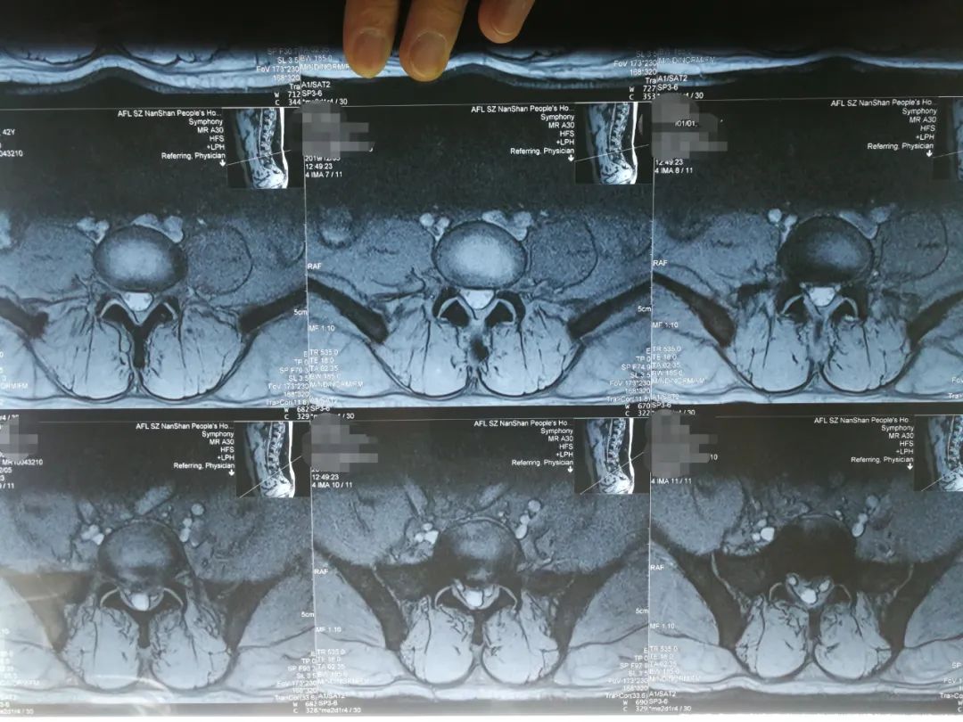 腰椎间盘突出症治疗，1个反射动作引出，提示治愈，医生很开心