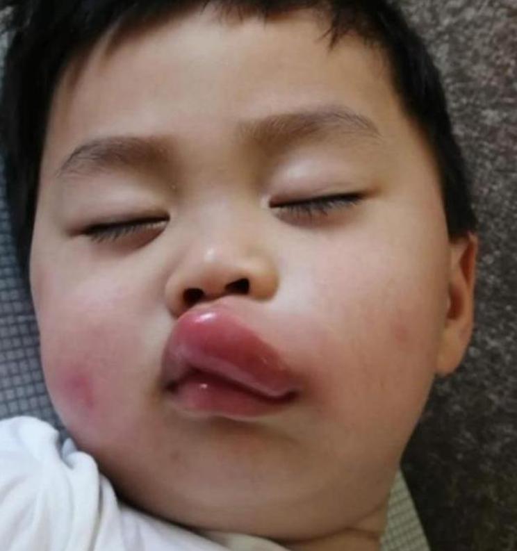 小孩嘴巴肿了一块,孩子一大早嘴巴肿了