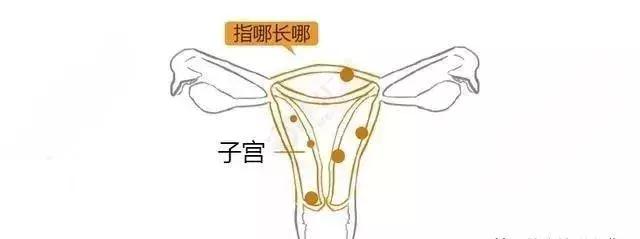 漫画详解子宫肌瘤是个啥？