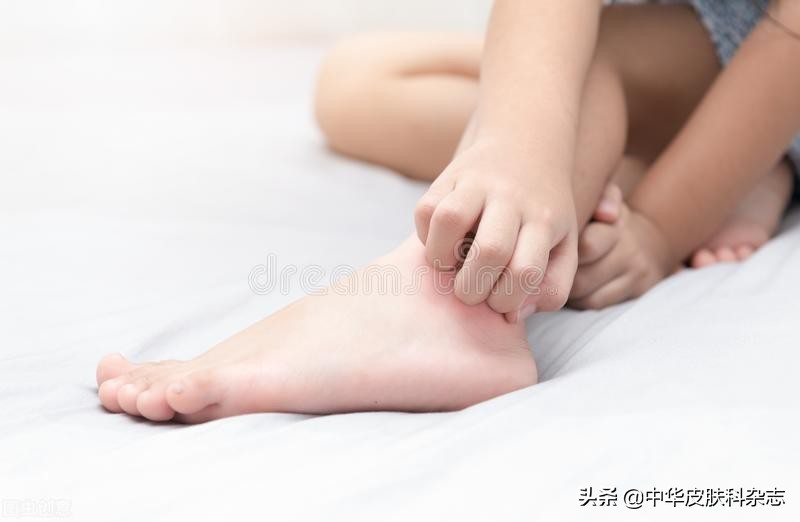 扁平苔藓这个病怎么治好啊,男性生殖器扁平苔藓多久能自愈