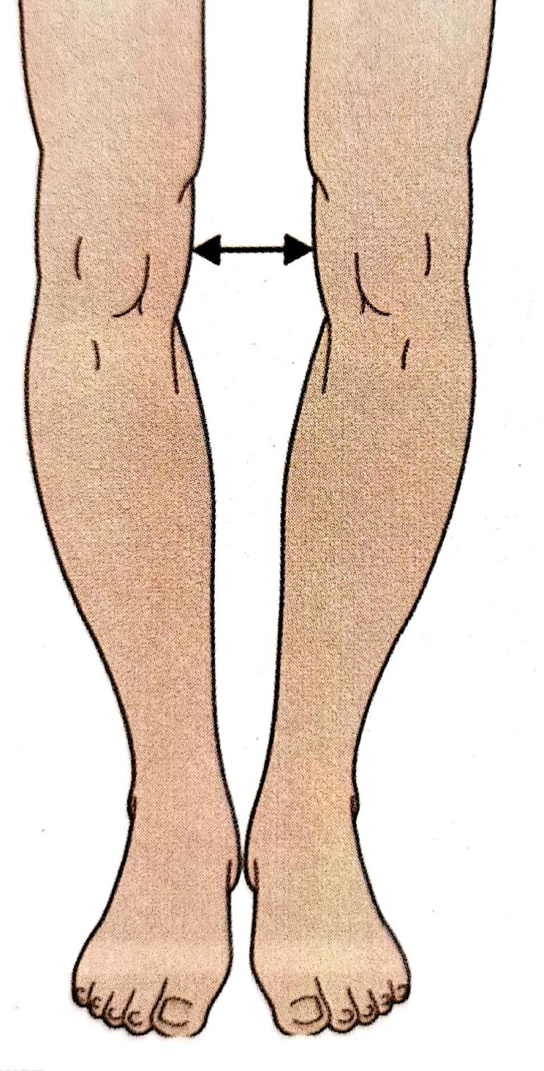 把o型腿变直手术过程,o型腿和xo型腿哪个更难矫正