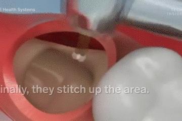 手术的时候医生对你做了什么,手术时切了一片肺叶