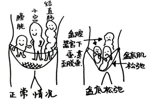 老年女性漏尿难言之隐,中老年女性漏尿最佳锻炼方法