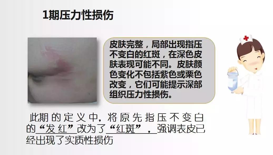 面对压疮不要慌,护理小妙招帮你忙!