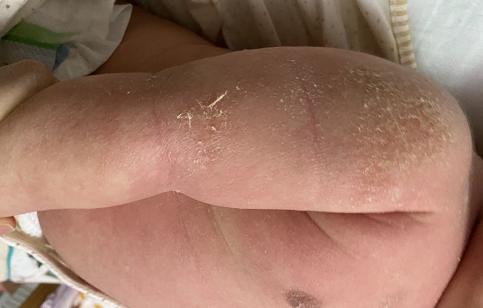 出生33天的宝宝长湿疹怎么办,新冠引起的湿疹怎么办