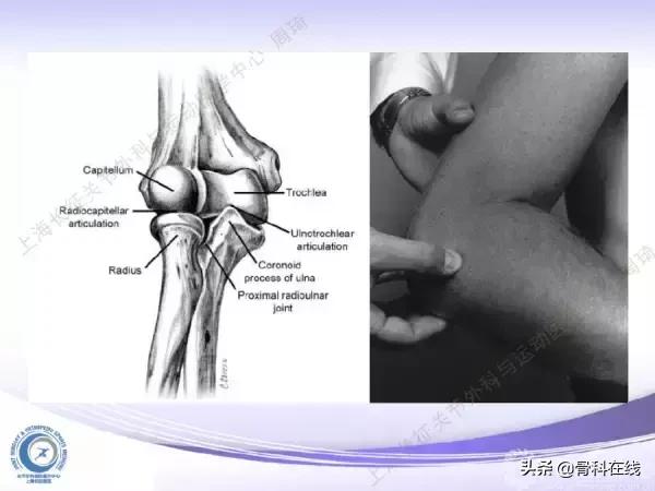 肘关节镜手术后引流,肘关节镜微创手术