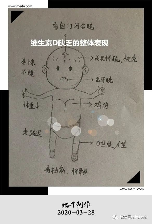 维生素d缺乏性佝偻病试题及答案,维生素d缺乏性佝偻病儿科护理学