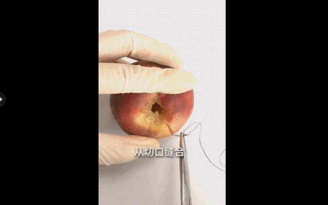 生小孩侧切会留下什么后遗症,顺产侧切后遗症多久可以运动