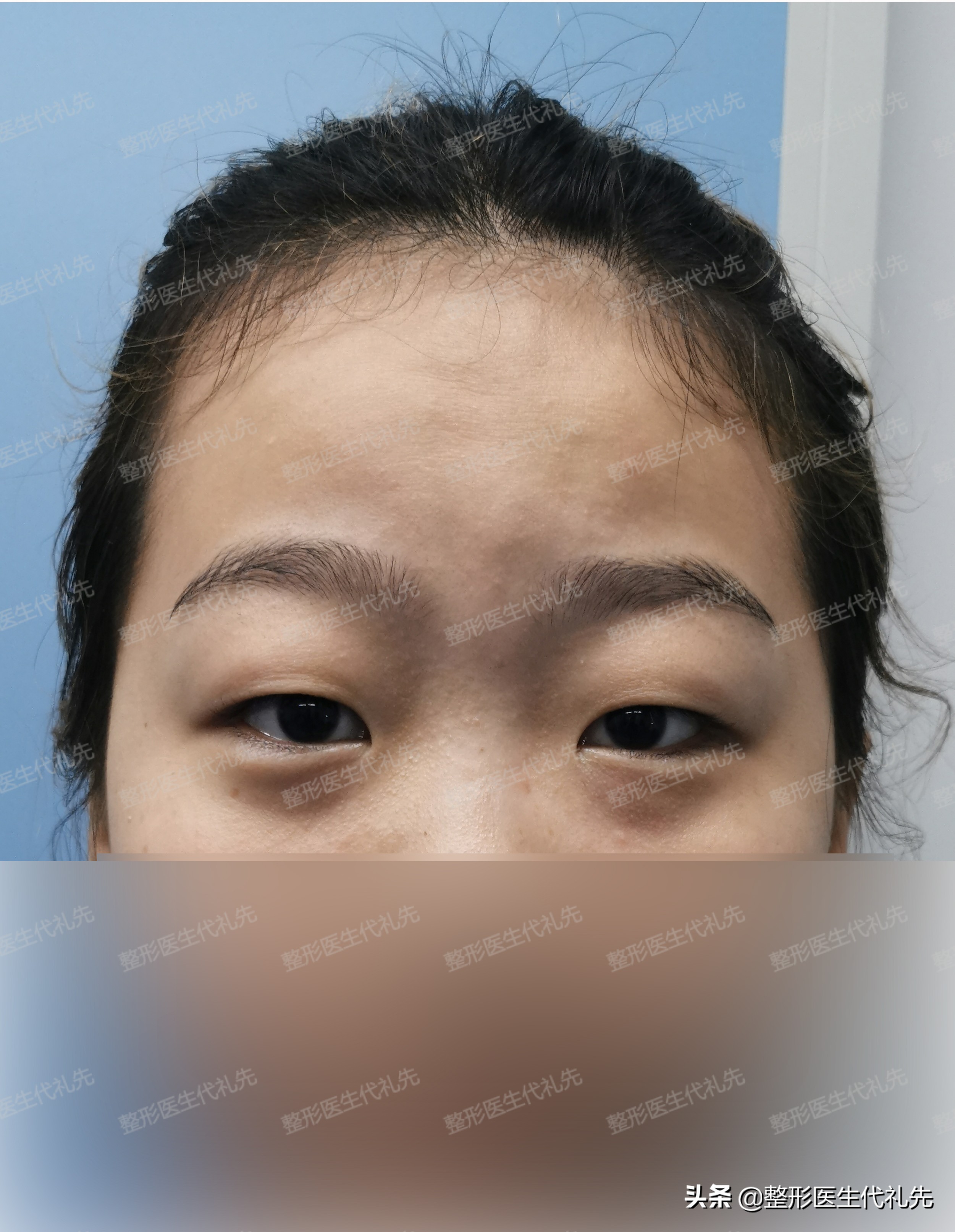 为什么刚做完双眼皮这么难看,为什么刚刚做的双眼皮不好看很假