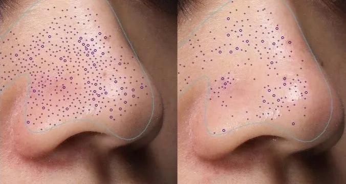 去黑头小窍门轻轻松松黑头一扫光,黑头太顽固教你去黑头的方法