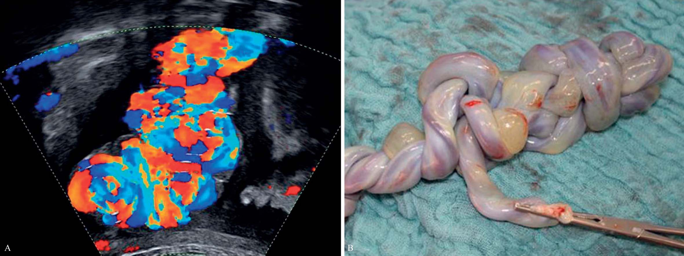 脐带超声表现,超声如何判断脐带绕颈几周