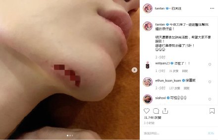 范玮琪下巴缝十五针，网友：“这是神的旨意，你可赶紧闭嘴吧！”
