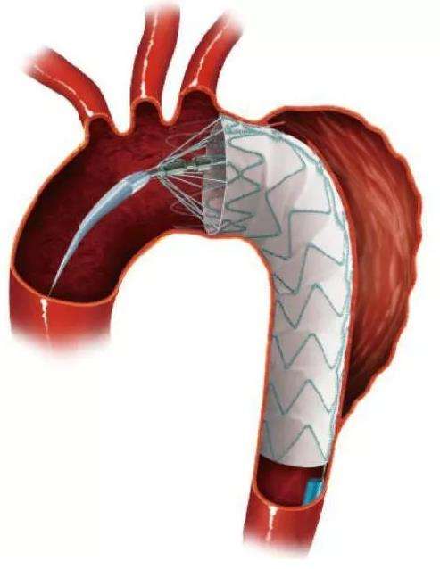 a型主动脉夹层为什么凶险,异常凶险的心脏病主动脉夹层