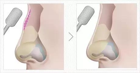 隆鼻能坚持到老吗,隆鼻的潜规则有哪些