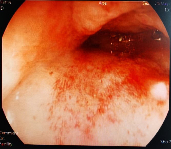 直肠癌吻合口狭窄的症状,直肠癌术后吻合口狭窄什么原因