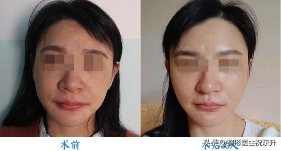 30岁皮肤松弛法令纹重怎么办,30多岁长了法令纹怎么办