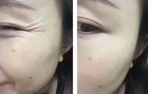 鱼尾纹眼袋怎么去除最有效,眼袋鱼尾纹怎么去除简单方法