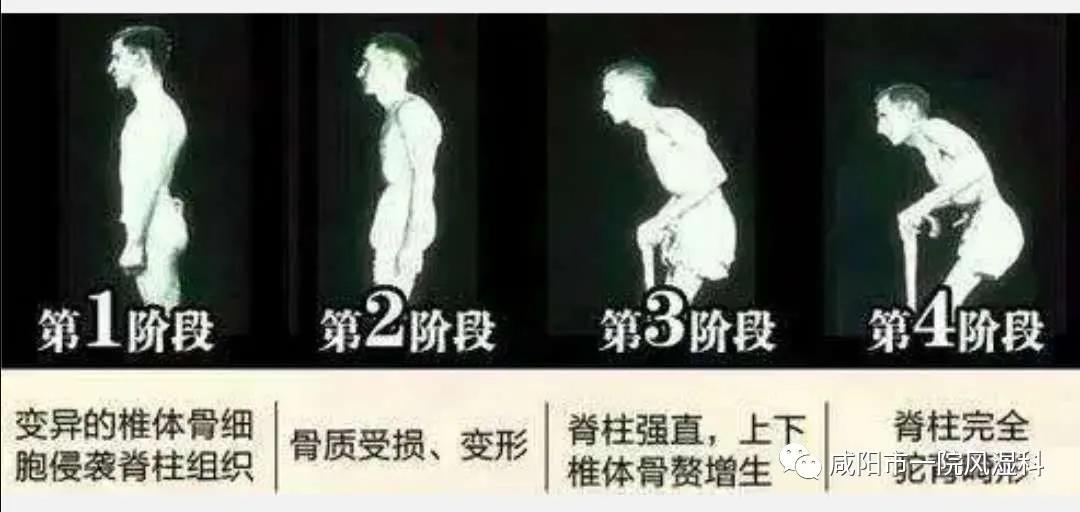 强直性脊柱炎被称不死的癌症,强直性脊柱炎不死的癌症