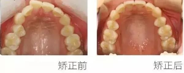 正畸主治学习视频,正畸钟摆效应名词解释