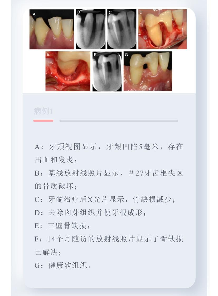 牙周病引起的牙髓病变的治疗原则,牙周组织可以修复再生吗