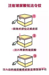 法令纹都是有什么方法可以去除,去法令纹最有效的办法明星