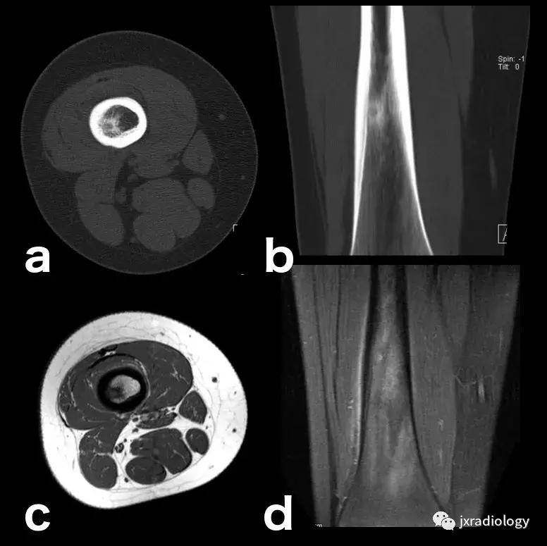 磁共振天天诊断骨髓水肿，但您知道原因吗？