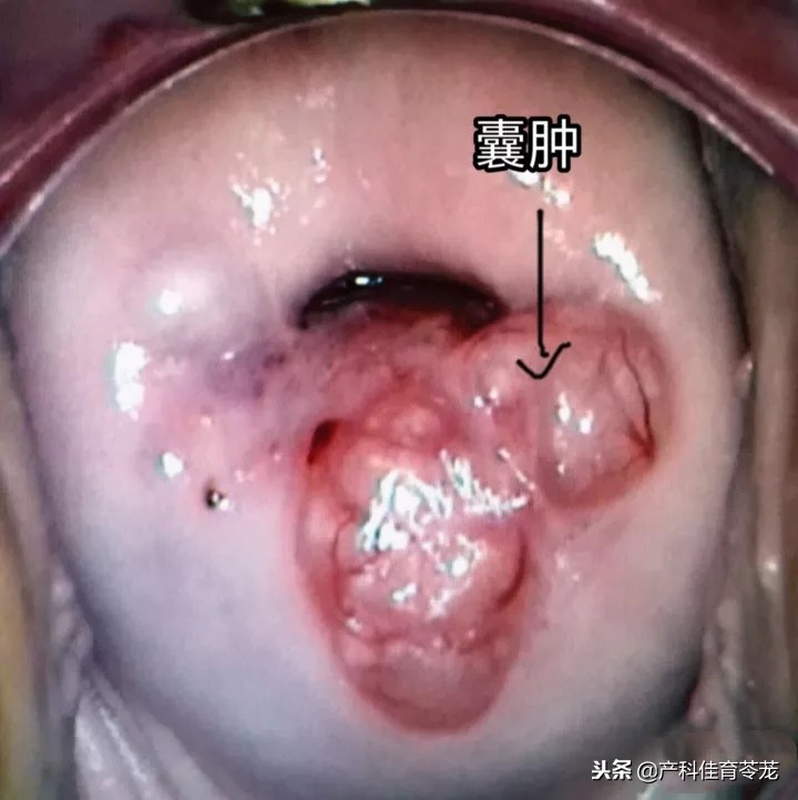 宫颈囊肿7*6mm纳氏囊肿需要治疗吗,宫颈囊肿巧克力囊肿