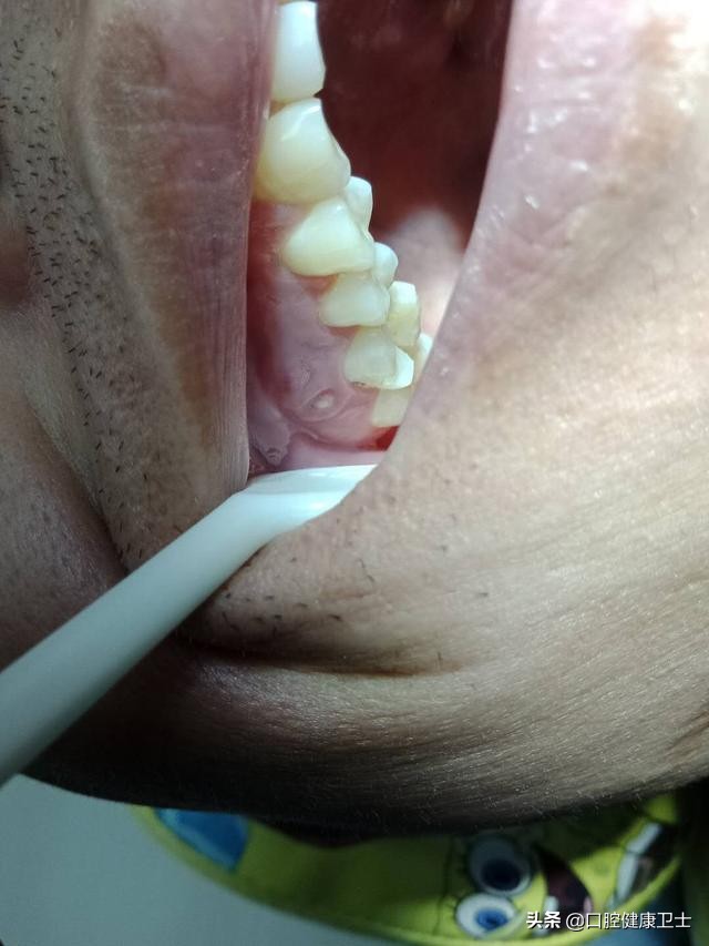 牙齿劈裂怎么处理,牙齿劈裂的补救方法