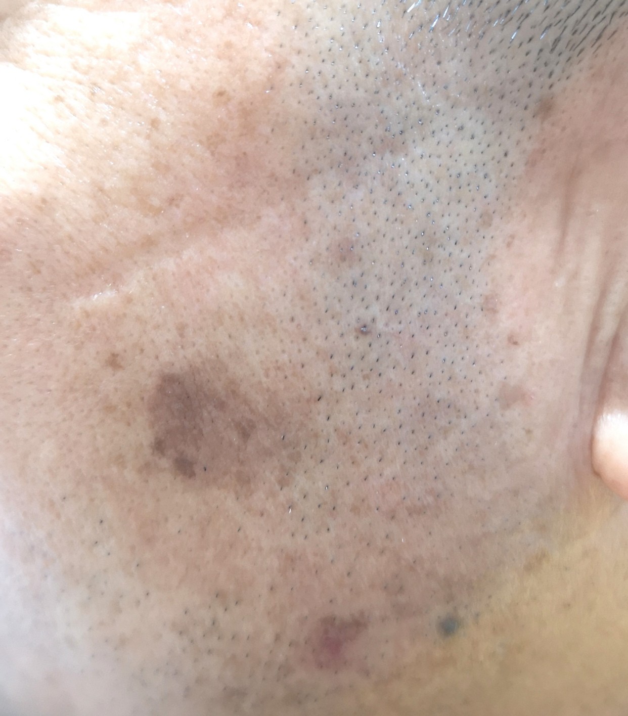 脸上的斑分为几种类型,脸上常见的6种斑