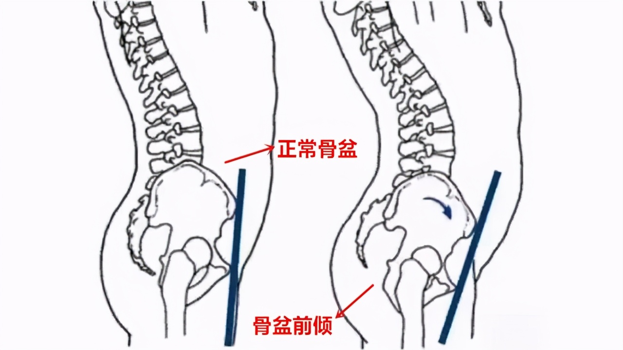 屁股翘腰疼怎么矫正,屁股翘会腰突吗