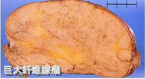 乳房肿块和纤维腺瘤,乳腺纤维腺瘤肿块有无血流信号