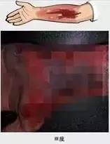 经常被烫伤割伤是犯了什么,烫烧伤怎么处理好得快