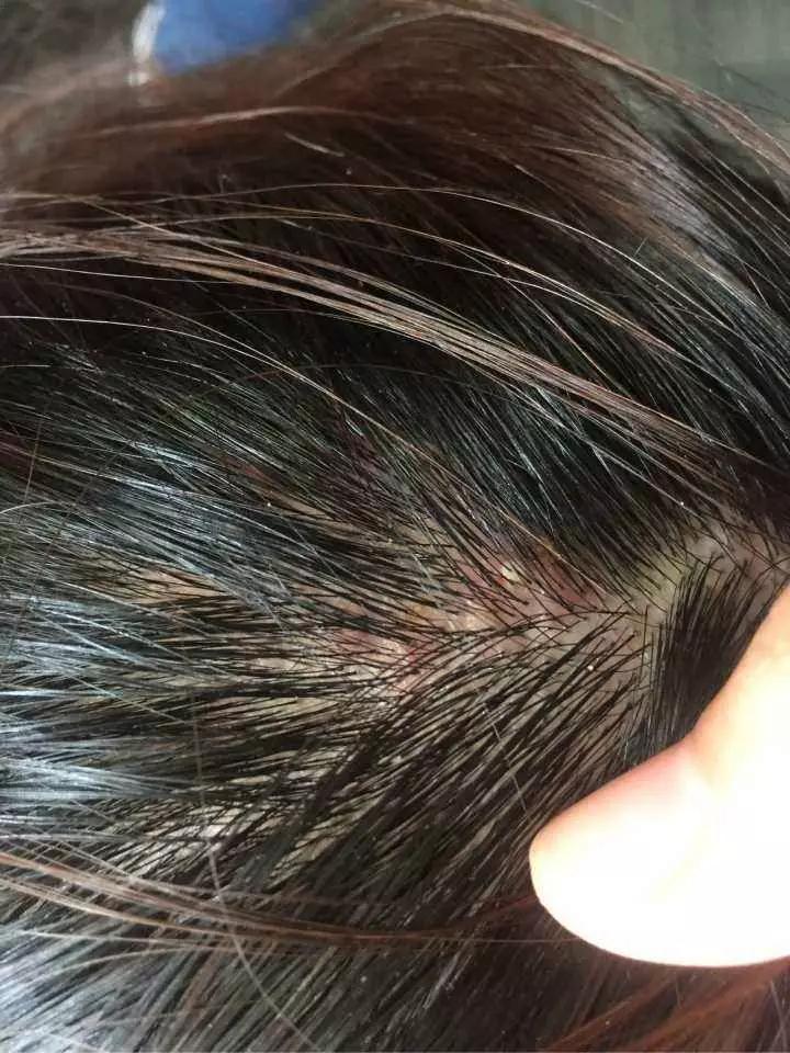 头皮屑多怎么办小妙招不需要钱,头皮屑多怎么办9个方法告别头屑