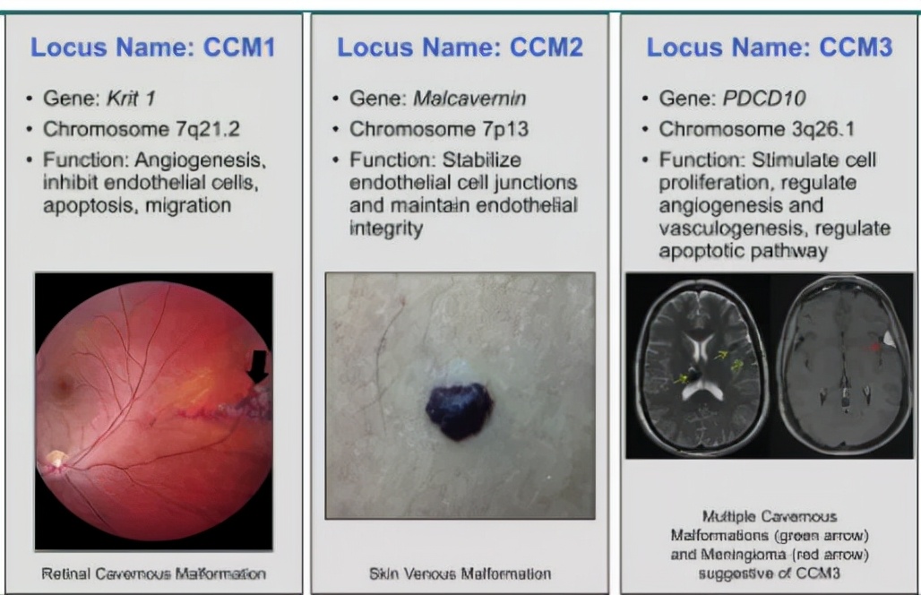 颅内海绵状血管瘤能治好吗,什么是颅内海绵状血管瘤