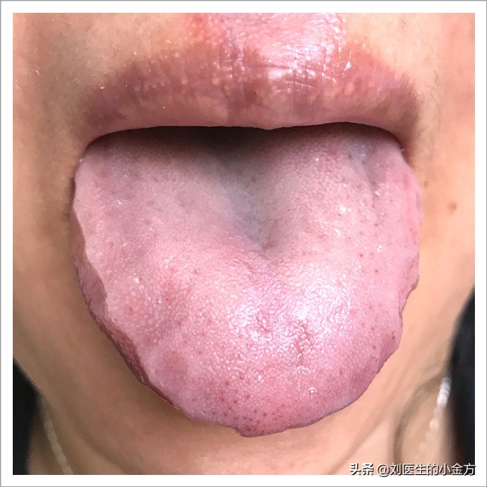 中医舌诊图解100例,中医舌诊图与舌诊口诀