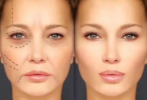 韦敏科普丨哪些原因会导致法令纹出现