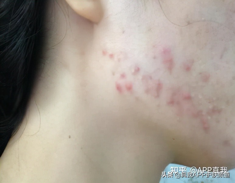 痘痘应该等它自己爆还是挤掉,长痘痘了要等它自己破掉吗