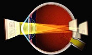 长期佩戴隐形眼镜如何护眼,戴了隐形几小时可以验光